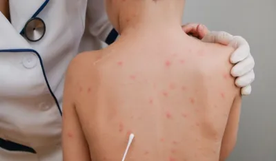 Raste broj oboljelih od morbila u Republici Srpskoj