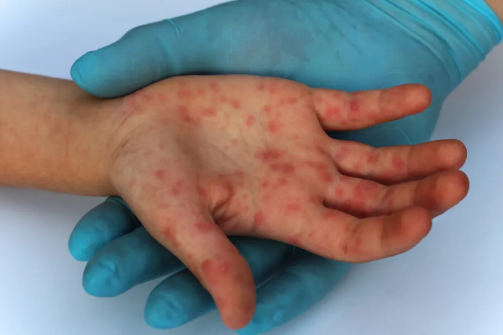 Iz IJZ-a upozoravaju na rizik od &scaron;irenja morbila: Prijeti velika epidemija, nevakcinisano 29.000 djece