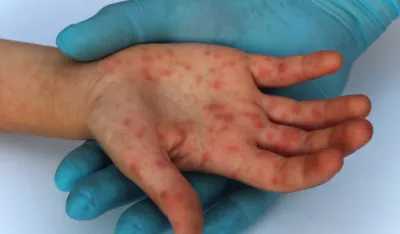 IJZ: Novi slučaj morbila registrovan u Rožajama