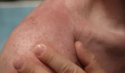 Ovaj rasprostranjen virus direktno utiče na nastanak karcinoma