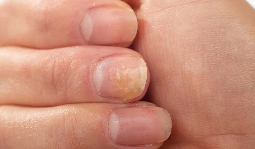 Kako prepoznati simptome psorijaze noktiju i na koji način ublažiti tegobe