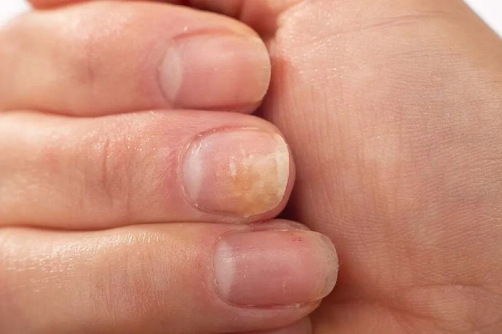 Kako prepoznati simptome psorijaze noktiju i na koji način ublažiti tegobe